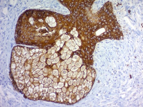 Cytokeratin, pan [PAN-CK (Cocktail)]