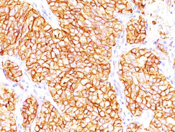 Renal Cell Carcinoma (RCC)/Proximal Nephrogenic Antigen [66.4.C2]