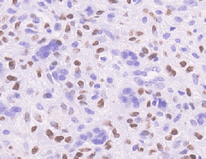 H3.3G34V [MD258R] RM0223_human giant cell tumor