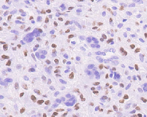 H3.3G34V [MD258R] RM0223_human giant cell tumor