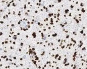 H3K27M [RM192] RM0106_human brain tumor